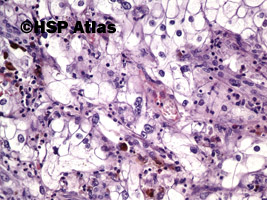 7. Rak jasnokomórkowy nerki, 3 stopień wg Fuhrmana (Clear Cell Renal Cell Carcinoma, Fuhrman Nuclear Grade 3), 20x