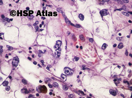 8. Rak jasnokomórkowy nerki, 3 stopień wg Fuhrmana (Clear Cell Renal Cell Carcinoma, Fuhrman Nuclear Grade 3), 40x