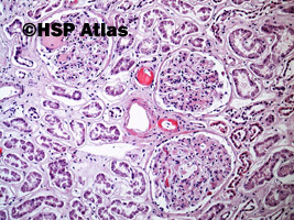 1. Nodular glomerulosclerosis, Kimmelstiel-Wilson disease, 10x