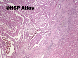 1. Rak brodawkowaty nerki, typ 2 (papillary renal cell carcinoma, type 2), 4x