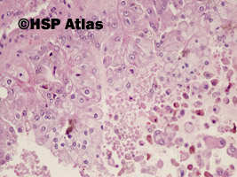 10. Rak brodawkowaty nerki, typ 2 (papillary renal cell carcinoma, type 2), 20x