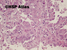 11. Rak brodawkowaty nerki, typ 2 (papillary renal cell carcinoma, type 2), 20x