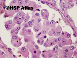 12. Rak brodawkowaty nerki, typ 2 (papillary renal cell carcinoma, type 2), 40x