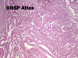 2. Rak brodawkowaty nerki, typ 2 (papillary renal cell carcinoma, type 2), 4x