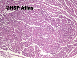 3. Rak brodawkowaty nerki, typ 2 (papillary renal cell carcinoma, type 2), 4x