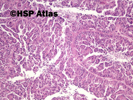 4. Rak brodawkowaty nerki, typ 2 (papillary renal cell carcinoma, type 2), 10x