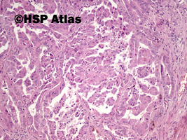 5. Rak brodawkowaty nerki, typ 2 (papillary renal cell carcinoma, type 2), 10x