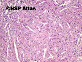 6. Rak brodawkowaty nerki, typ 2 (papillary renal cell carcinoma, type 2), 10x