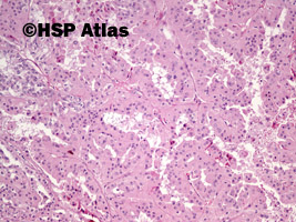 8. Rak brodawkowaty nerki, typ 2 (papillary renal cell carcinoma, type 2), 10x