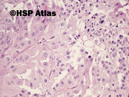 9. Rak brodawkowaty nerki, typ 2 (papillary renal cell carcinoma, type 2), 20x