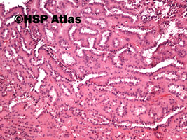 1. Papillary renal cell carcinoma, type 1, 10x