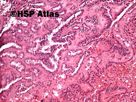 2. Papillary renal cell carcinoma, type 1, 10x