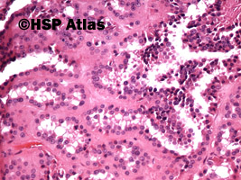 4. Papillary renal cell carcinoma, type 1, 20x