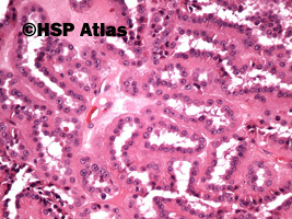 5. Papillary renal cell carcinoma, type 1, 20x