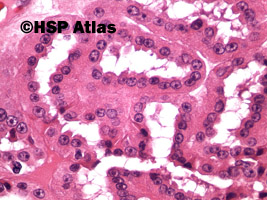 6. Papillary renal cell carcinoma, type 1, 40x