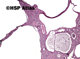 1. Wielotorbielowatość nerek, typu dorosłego (autosomal dominant (adult) polycystic kidney disease), 4x