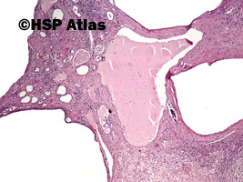 2. Wielotorbielowatość nerek, typu dorosłego (autosomal dominant (adult) polycystic kidney disease), 4x