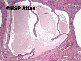 4. Wielotorbielowatość nerek, typu dorosłego (autosomal dominant (adult) polycystic kidney disease), 4x