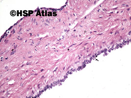 8. Wielotorbielowatość nerek, typu dorosłego (autosomal dominant (adult) polycystic kidney disease), 20x