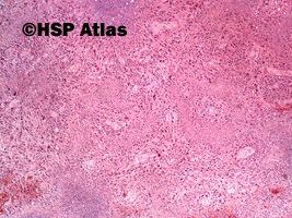1. Rak urotelialny, typ mięsakowy (sarcomatoid urothelial carcinoma), 4x