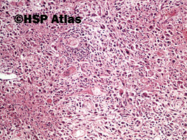 2. Rak urotelialny, typ mięsakowy (sarcomatoid urothelial carcinoma), 10x