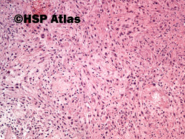 3. Rak urotelialny, typ mięsakowy (sarcomatoid urothelial carcinoma), 10x