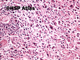 4. Rak urotelialny, typ mięsakowy (sarcomatoid urothelial carcinoma), 20x