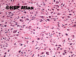 5. Rak urotelialny, typ mięsakowy (sarcomatoid urothelial carcinoma), 20x