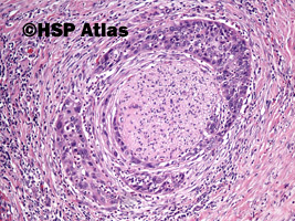 1. Rak urotelialny miedniczki nerkowej (urothelial carcinoma of renal pelvis), 10x