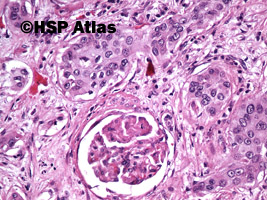 10. Rak urotelialny miedniczki nerkowej (urothelial carcinoma of renal pelvis), 20x