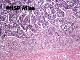 2. Rak urotelialny miedniczki nerkowej (urothelial carcinoma of renal pelvis), 4x