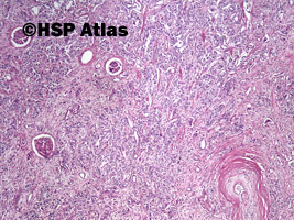 3. Rak urotelialny miedniczki nerkowej (urothelial carcinoma of renal pelvis), 4x