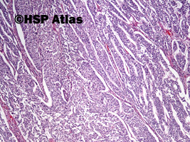 4. Rak urotelialny miedniczki nerkowej (urothelial carcinoma of renal pelvis), 4x