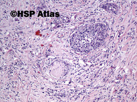 5. Rak urotelialny miedniczki nerkowej (urothelial carcinoma of renal pelvis), 10x
