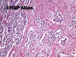 6. Rak urotelialny miedniczki nerkowej (urothelial carcinoma of renal pelvis), 10x