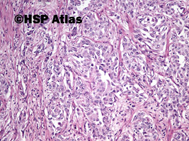 7. Rak urotelialny miedniczki nerkowej (urothelial carcinoma of renal pelvis), 10x