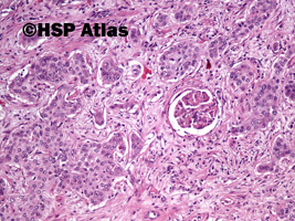 8. Rak urotelialny miedniczki nerkowej (urothelial carcinoma of renal pelvis), 10x