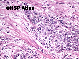 9. Rak urotelialny miedniczki nerkowej (urothelial carcinoma of renal pelvis), 20x