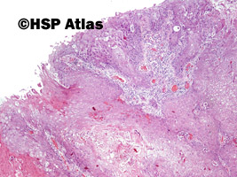 1. Rak urotelialny z różnicowaniem płaskonabłonkowym (urothelial carcinoma with squamous differentiation), 4x