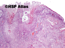 2. Rak urotelialny z różnicowaniem płaskonabłonkowym (urothelial carcinoma with squamous differentiation), 4x