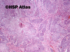 3. Rak urotelialny z różnicowaniem płaskonabłonkowym (urothelial carcinoma with squamous differentiation), 4x
