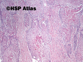 4. Rak urotelialny z różnicowaniem płaskonabłonkowym (urothelial carcinoma with squamous differentiation), 4x