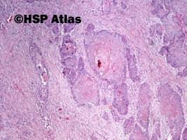 5. Rak urotelialny z różnicowaniem płaskonabłonkowym (urothelial carcinoma with squamous differentiation), 4x