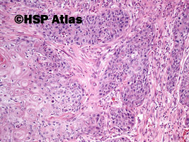 6. Rak urotelialny z różnicowaniem płaskonabłonkowym (urothelial carcinoma with squamous differentiation), 10x