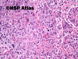 7. Rak urotelialny z różnicowaniem płaskonabłonkowym (urothelial carcinoma with squamous differentiation), 20x