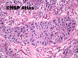 8. Rak urotelialny z różnicowaniem płaskonabłonkowym (urothelial carcinoma with squamous differentiation), 20x