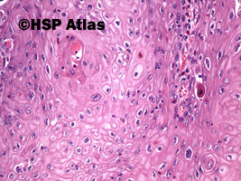 9. Rak urotelialny z różnicowaniem płaskonabłonkowym (urothelial carcinoma with squamous differentiation), 20x