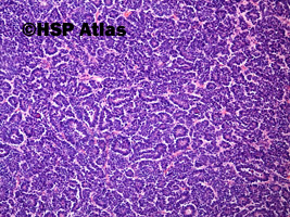 1. Wilms tumor, nephroblastoma, epithelial type, 10x