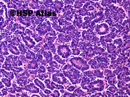 2. Wilms tumor, nephroblastoma, epithelial type, 20x