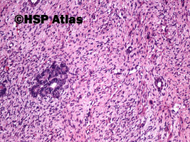 11. Wilms tumor, nephroblastoma, stromal type, 10x